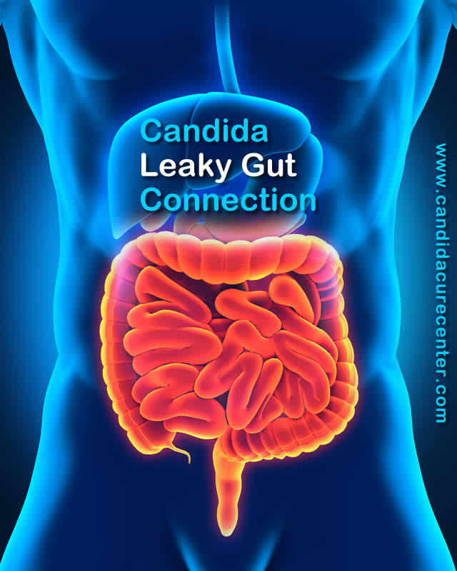 candida albicans leaky gut ccws – Candida Cure Center